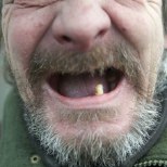 Kolme hambaga maamees: 76eurose sissetulekuga hambaid ei ravi