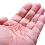 Kuidas hooldada atoopilist nahka?