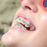 Puseriti hambad sirgesse ritta: breketite või kapedega?