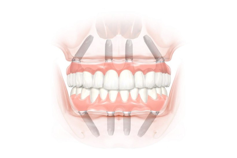 Kui olete mingil põhjusel kaotanud oma hambad, siis on lahenduseks ALL-ON-4 või ALL-ON-6 hambaimplantaadid!
