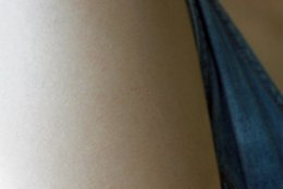 Sünnimärkidega kaetud käsivarred ennustavad nahavähkiriski