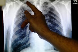Soome ametikoolis avastati välistudengil tuberkuloos