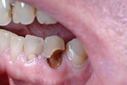 Ettevaatust! Lagunenud hambad mõjutavad kogu organismi tervist